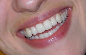 FEATURE: Should you get veneers for that perfect smile?